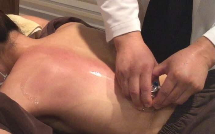 カッピングの効果